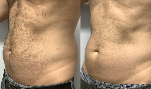 Body Sculpting TruBody Before After Mississauga Oakville